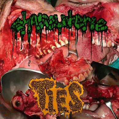 Charcuterie : Total Maxillectomy Charcuterie : Total Maxillectomy